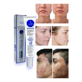 Crema Anti Acné Elimina Granos Espinillas Tratamiento 30g Momento De Aplicación Noche Tipo De Piel Mixta