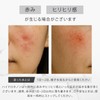 SLASH Hydroquinone Cream, High Concentration, 6.0% Pure, Hydroquinone, Azelic Acid,