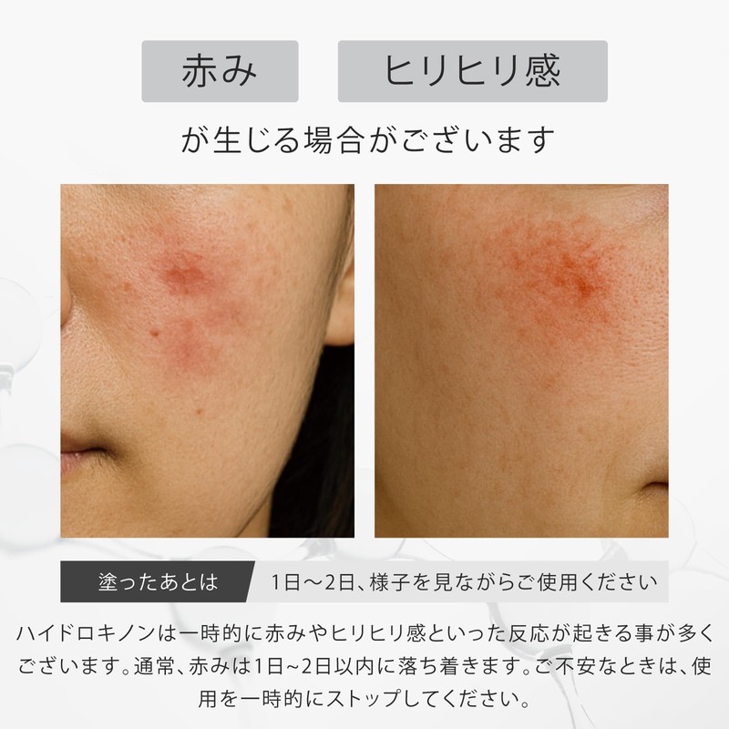 SLASH Hydroquinone Cream, High Concentration, 6.0% Pure, Hydroquinone, Azelic Acid,