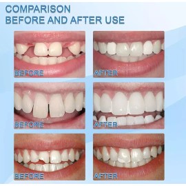 Reparación De Dientes, Sólido,temporal Duradero,reutilizable