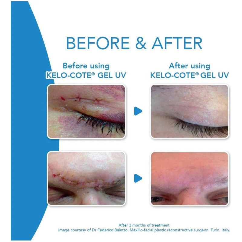 Kelo-cote Gel Para Las Cicatrices 15 G Tipo De Piel