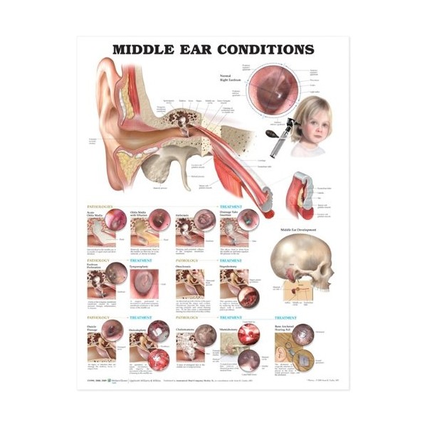 Middle Ear Conditions Anatomical Chart