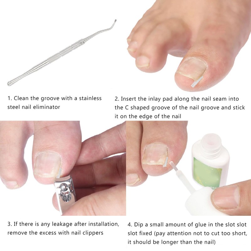 Kit de Eliminación de Uñas Encarnadas, 50 PCS Corrector de