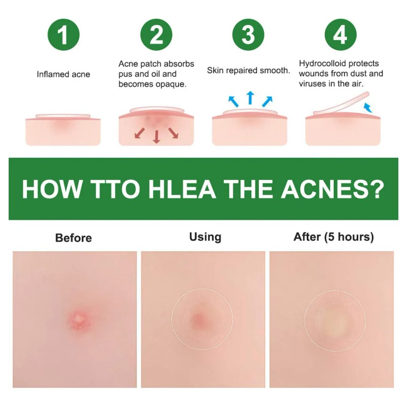 Parche Trasparente Antiacné Absorve Impurezas Protege Piel