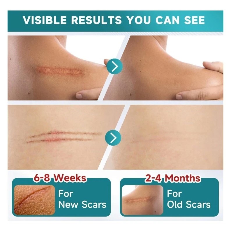Pumkot Silicone Scar Tape Roll 1.6"x120" Surgical Scars Keloid Burn