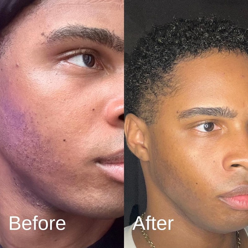 Acne System for Men and Boys, Face Wash, Moisturizer, Pimple