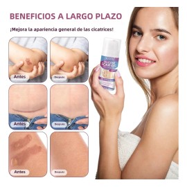 Scar Gel Vogsig Elimina Cicatrices Queloide Abdominoplastia