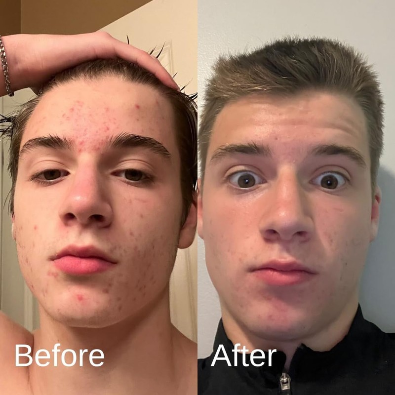 Acne System for Men and Boys, Face Wash, Moisturizer, Pimple