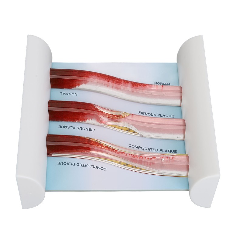 Lipoprotein LDL Blood Vessel Model Low Density Blood Lipid Vessel