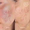 THERAMID AZID - 15% Azelaic Acid Treatment
