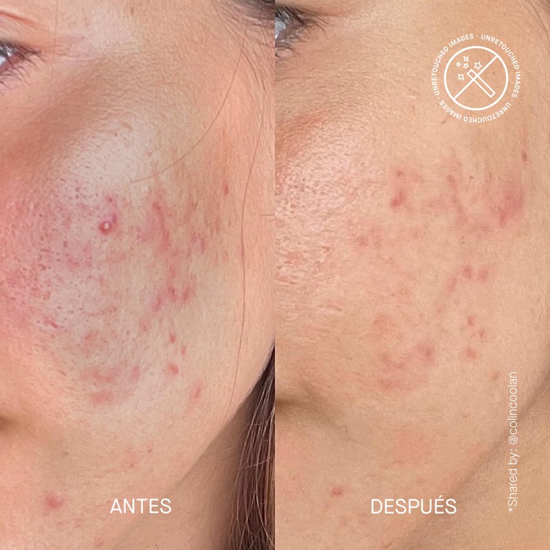 THERAMID AZID - 15% Azelaic Acid Treatment