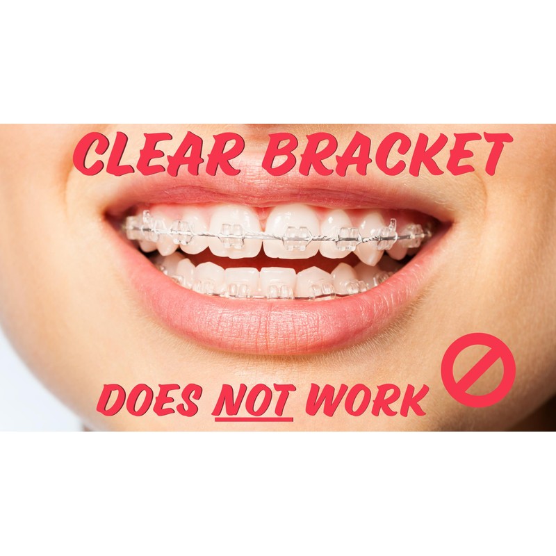 Snapcaps Braces Bumper Cover, Orthodontic Bracket Wax Substitute, Alternative Snap-on