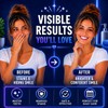 ZABERRY Teeth Whitening Kit with 2 x 10ml Gel +