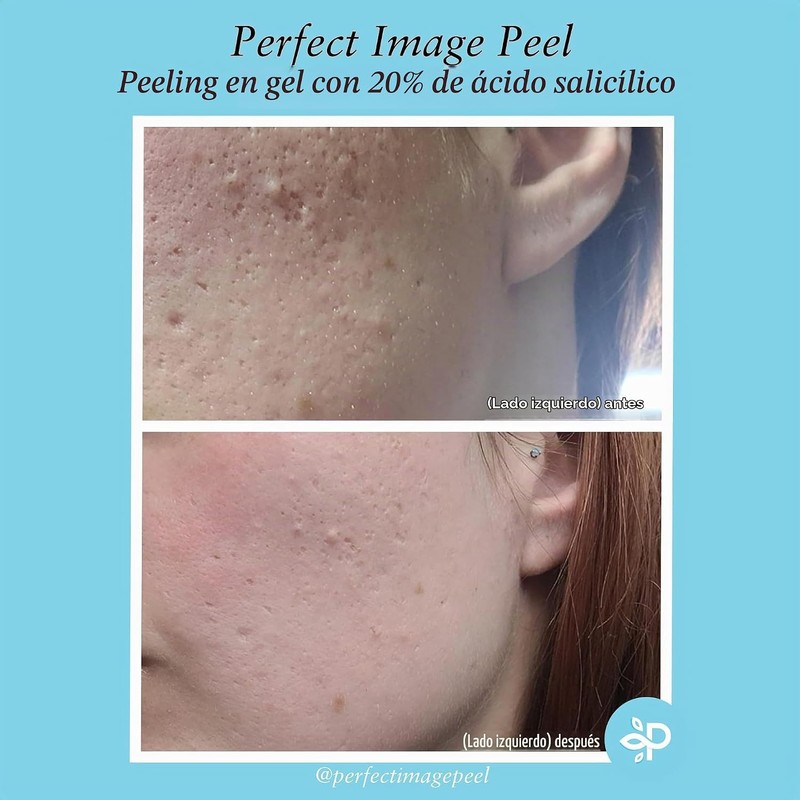 Salicylic Acid 20% Gel Peel - Enhanced with Tea Tree
