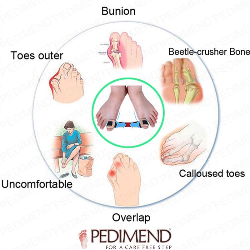 Pedimend™ Toe Belt | Bunion Exercise Aid Corrector Treatment |
