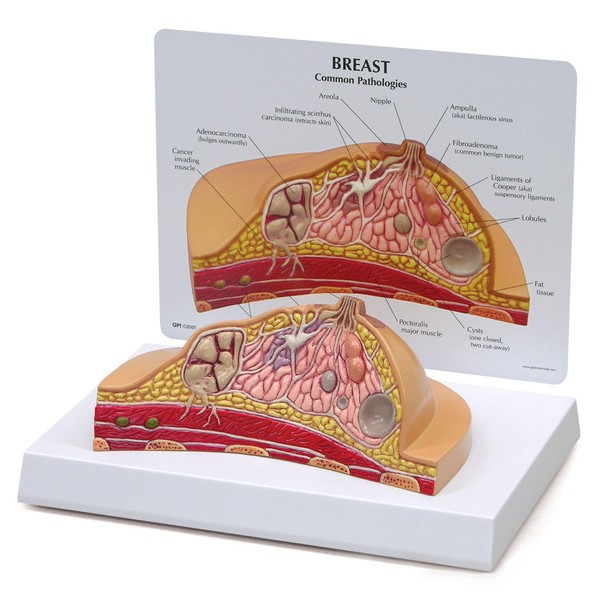 GPI Anatomicals - Breast Cross-Section Model, Replica Showing Common Pathologies for Human Anatomy, Physiology Education, Anatomy Model for Doctor's Offices and Classrooms, Medical Learning Resources