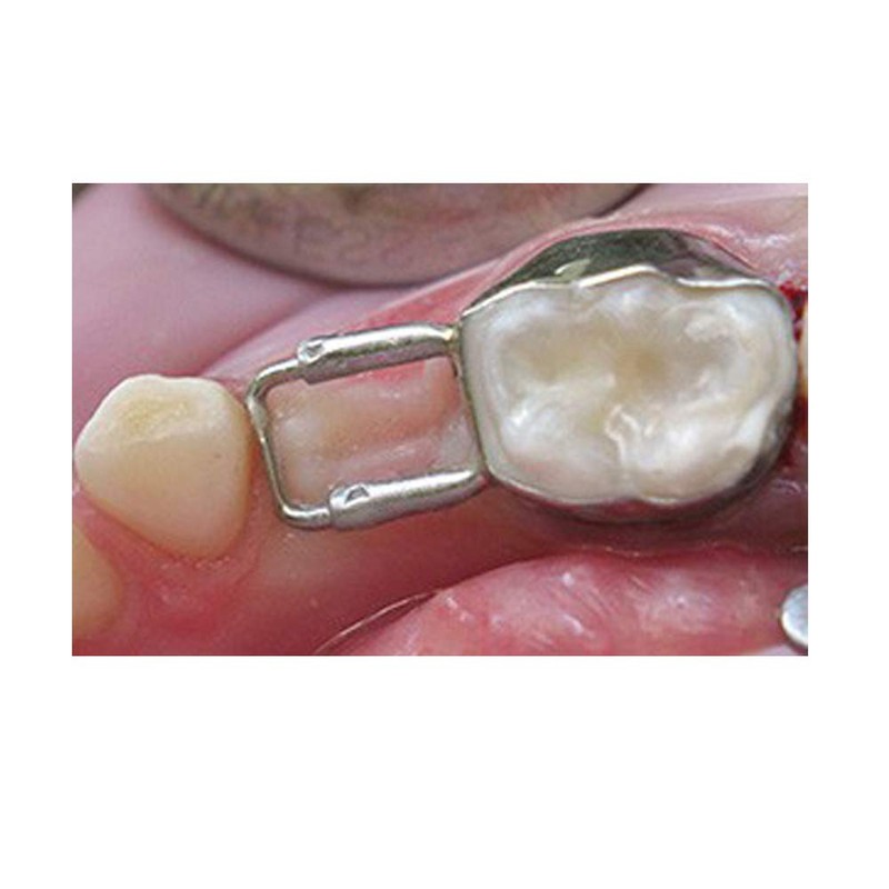 J&J Ortho Preformed Space Maintainer Band & Loop (4/pk) (#34)