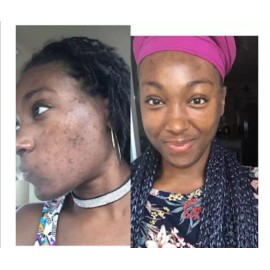 Herbal Power Peel Green Herbal Algae Peel- Acne Treatment Soap Oily, Pimples, Blemishes, Healing