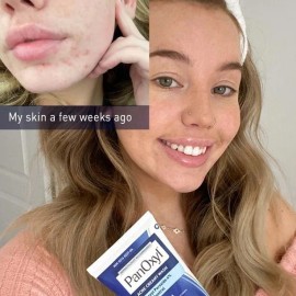 Panoxyl Acné Creamy Facial Wash 4% Peróxido De Benzoilo Usa