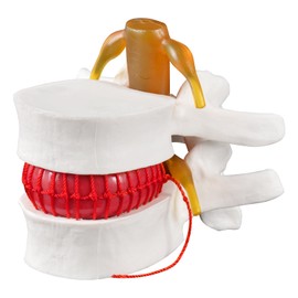Simedutech Human Anatomical Lumbar Disc Herniation Model - 1.5X Life Size Lumbar Spine Teaching Tool for Medical Education & Scientific Presentations,for Demonstrating Disc