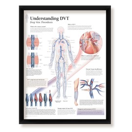 Understanding DVT Deep Vein Thrombosis Framed Medical Educational Informational Poster Diagram Doctors Office School Classroom 22x28 Inches