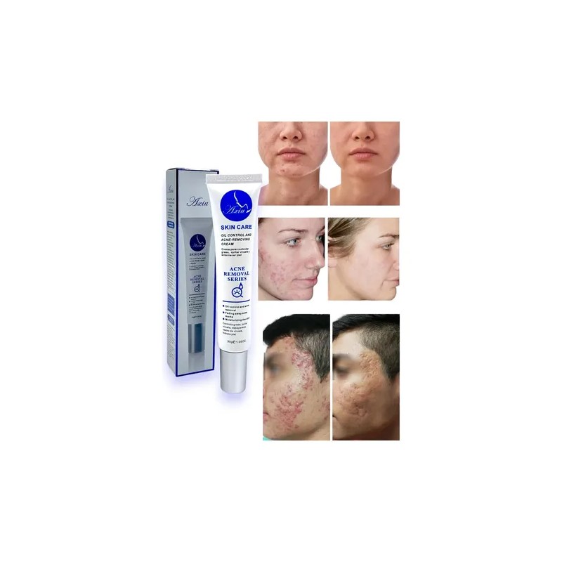Crema Anti Acné Elimina Granos Espinillas Tratamiento 30g