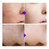 Tratamiento Antiacne Control Poros Manchas Espinillas 35ml