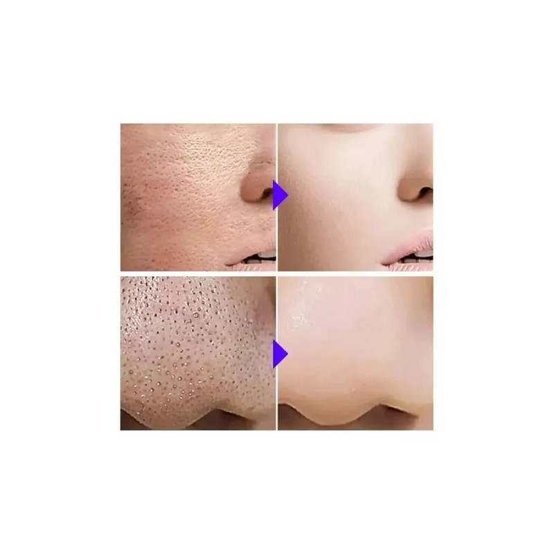 Tratamiento Antiacne Control Poros Manchas Espinillas 35ml