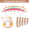 Ingrown Toenails Set, Toenail Correction, Toenail Patch, Toenail Correction Patch,