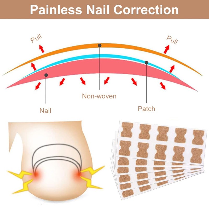 Ingrown Toenails Set, Toenail Correction, Toenail Patch, Toenail Correction Patch,