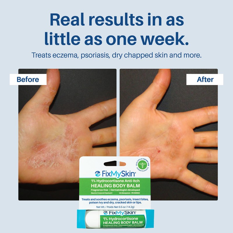 FixMySkin 1% Hydrocortisone Healing Body Balm – Fast Itch Relief,