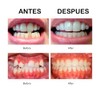Retenedor De Dientes Para Corrección De Sonrisa 3 Etapas Dispositivo