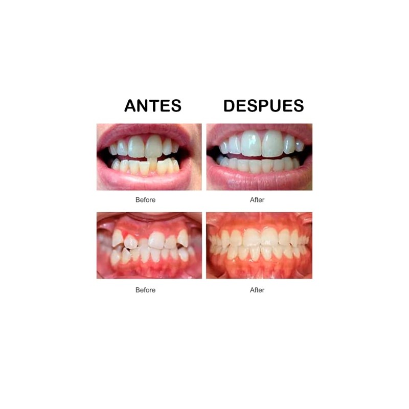 Retenedor De Dientes Para Corrección De Sonrisa 3 Etapas Dispositivo