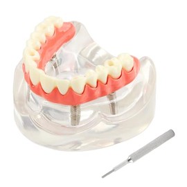 Modelo de implante dental para mandíbula superior extraíble 4 implantes modelo de restauración | Modelo de demostración de sobredentura, educación y estudio de estudiantes dentales