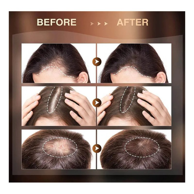 Sérum Re:act Minoxi Roll-on Para El Crecimiento Del Cabello,