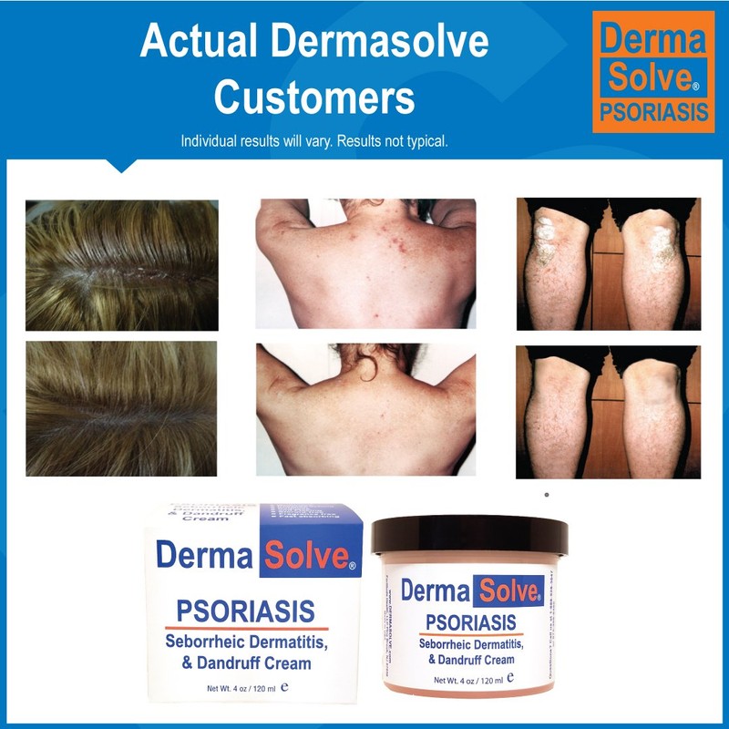Dermasolve Psoriasis Complete Body & Scalp Kit