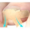 Veraly Pegatinas Correctoras De Uñas Enterradas Dolor 4 Plantillas