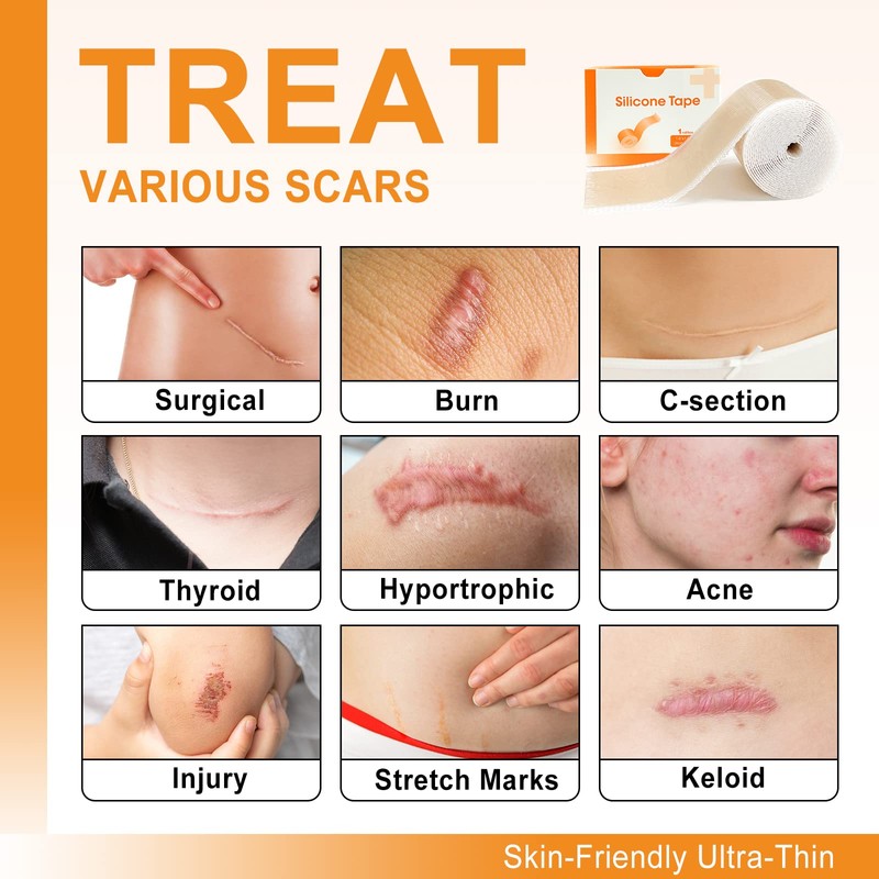 Carbou Silicone Scar Sheets (1.6"x 60"Roll) Medical Silicone Scar Tape