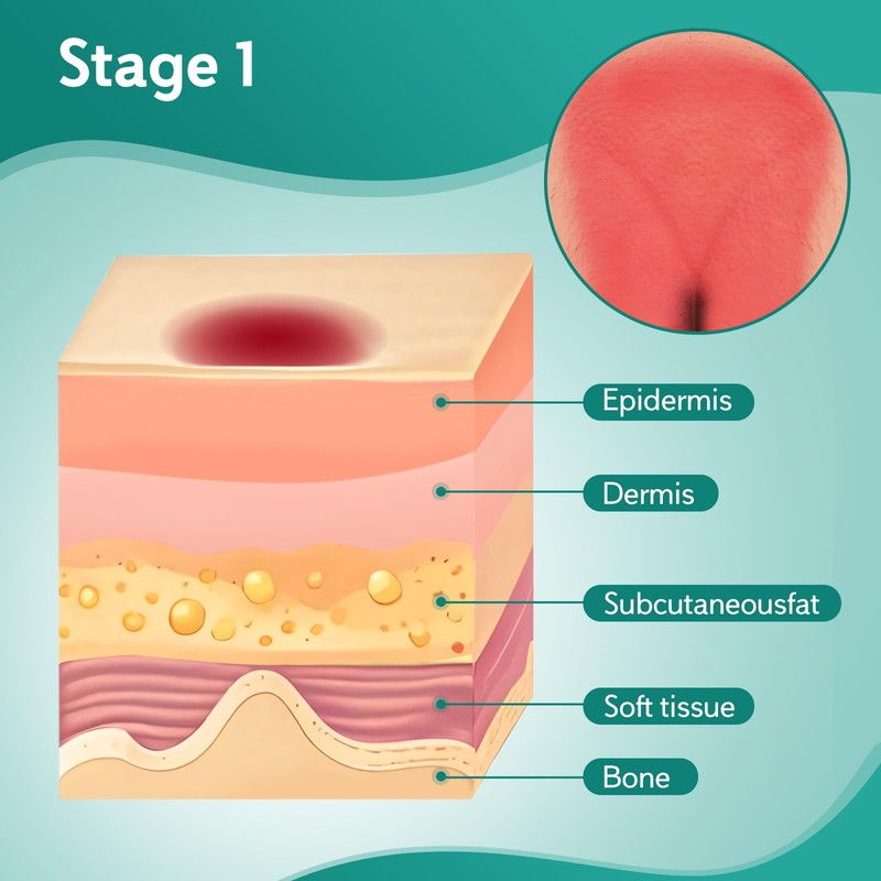 MedEduQuest Decubitus Ulcer Wound Care Model, Bedsores Model, Pressure Injury