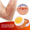 Crema Eliminar Psoriasis Extracto Herbal Sumifun 10 Grs 2 unidades