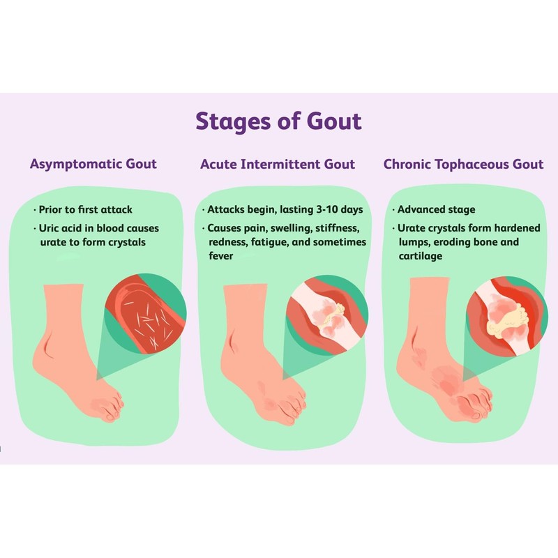 Uric Acid Gout Urine Test Strips GP/Pro Use CE Marked