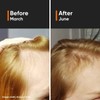 Minimalist 18% Hair Growth Serum with Redensyl - Grow thicker,