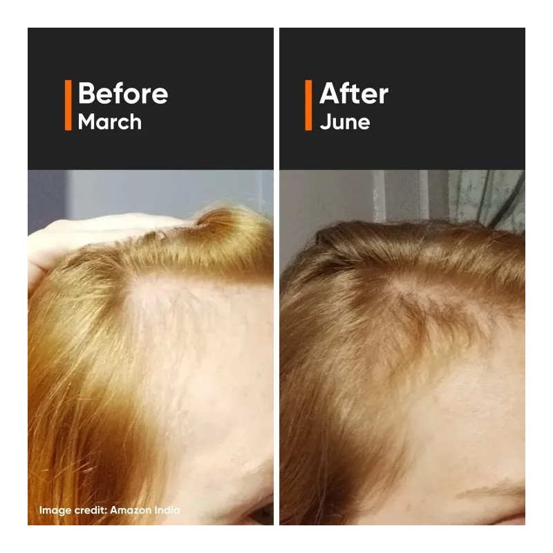 Minimalist 18% Hair Growth Serum with Redensyl - Grow thicker,