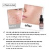 Caramel Japan Serum Acne 5ml - Skincare Skin Repair Comfort
