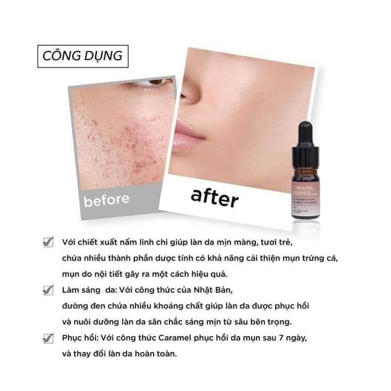 Caramel Japan Serum Acne 5ml - Skincare Skin Repair Comfort