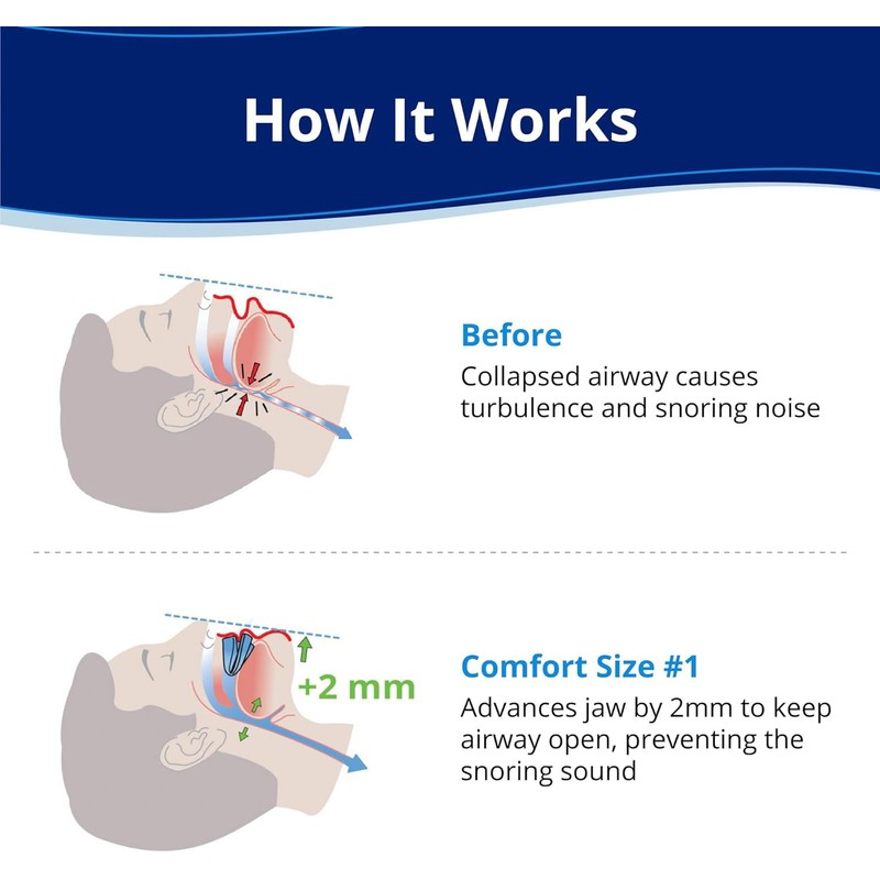 いびき防止マウスピース、コンフォートサイズ#1、シングルリフィル、ブルー、米国製、BPAフリー、医療グレード素材 (Blue)