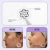 Magnesium Blemish Microdarts | Pimple Patch | Cystic Acne |