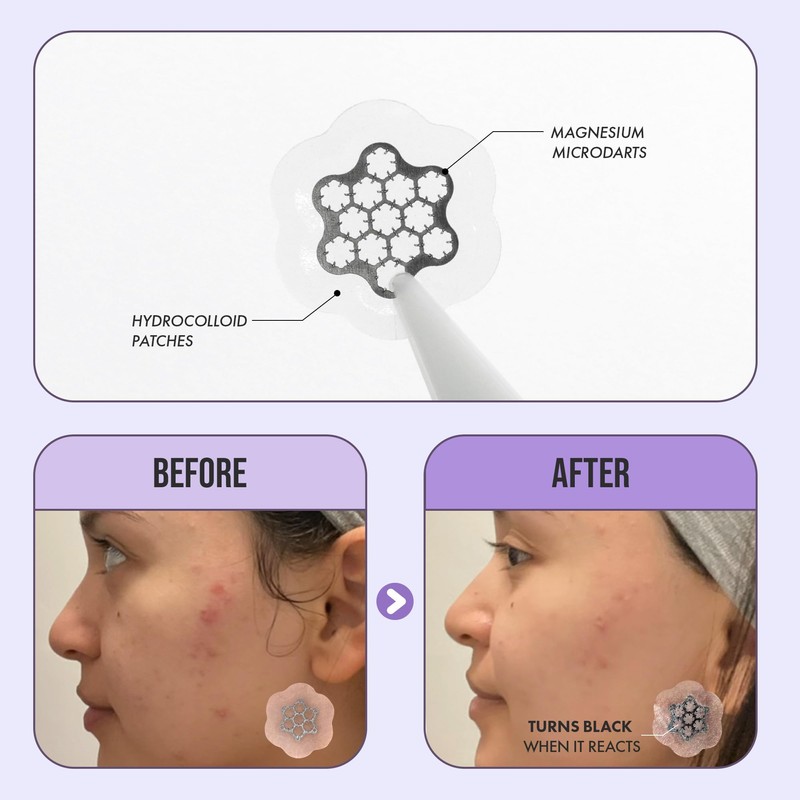 Magnesium Blemish Microdarts | Pimple Patch | Cystic Acne |