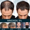Tratamiento Para Cabello Y Barba Para El Crecimiento Del Cab