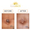 Keloid Removal Removal Duo